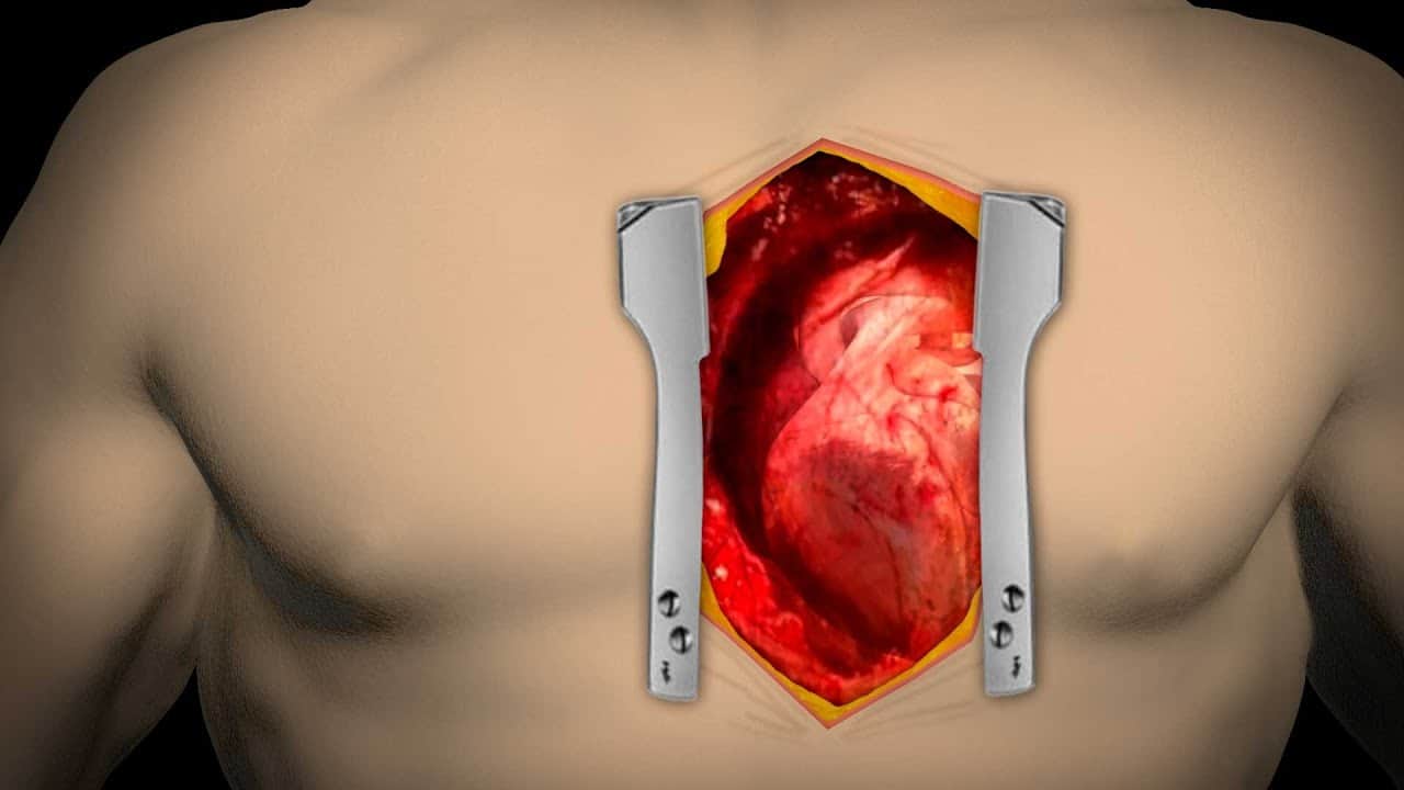 Bypass SGK Karşılıyor Mu