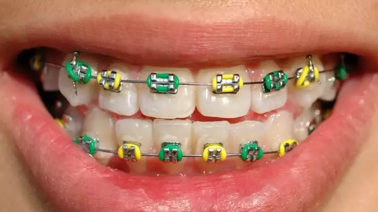 SGK Diş Telinin Ne Kadarını Karşılıyor